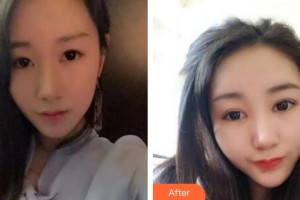 潛江白衣天使醫(yī)療美容診所于濤整形價(jià)格表附眼部綜合案例展示