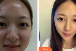 潛江亞美醫(yī)療美容診所劉敏先整形價(jià)格表附切開(kāi)雙眼皮案例展示