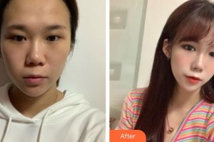 潛江白衣天使醫(yī)療美容診所江岳整形價(jià)格表附眼部綜合案例展示