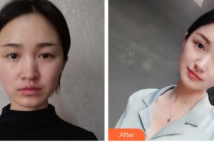 天門(mén)江岳醫(yī)療美容診所李龍整形價(jià)格表附眼部綜合案例展示