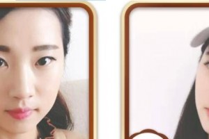 天門(mén)愛(ài)爾眼科醫(yī)院王智琦整形價(jià)格表附眼部綜合案例展示