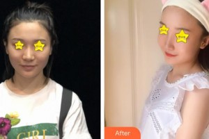 天門(mén)愛(ài)爾眼科醫(yī)院周君平整形價(jià)格表附眼部綜合案例展示