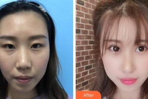 天門(mén)明保眼科醫(yī)院倪明保整形價(jià)格表附眼部綜合案例展示