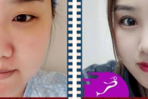 天門(mén)明保眼科醫(yī)院付德華整形價(jià)格表附眼部綜合案例展示