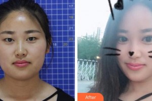 天門(mén)愛(ài)爾眼科醫(yī)院熊俊玲整形價(jià)格表附切開(kāi)雙眼皮案例展示