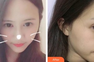 牡丹江紅旗醫(yī)院整形美容科趙曉崢整形價(jià)格表附眼部綜合案例展示