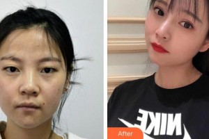 牡丹江市回民醫(yī)院燒傷整形科蘭久利整形價格表附切開雙眼皮案例展示