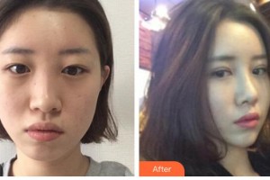 牡丹江鄒倩醫(yī)療美容診所鄒倩整形價(jià)格表附切開(kāi)雙眼皮案例展示