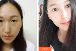 伊春王霞醫(yī)療美容診所王霞整形價(jià)格表附切開(kāi)雙眼皮案例展示