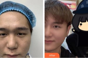 萍鄉(xiāng)漢和醫(yī)院美容整形中心唐家訓整形價格表附開內(nèi)眼角案例展示