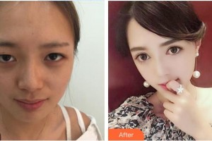 萍鄉(xiāng)麗芙整形美容醫(yī)院張志宏整形價格表附切開雙眼皮案例展示