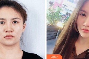 萍鄉(xiāng)市人民醫(yī)院美容整形科譚昶整形價格表附眼部綜合案例展示