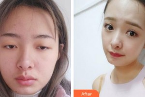萍鄉(xiāng)麗芙整形美容醫(yī)院洪曼珊整形價格表附切開雙眼皮案例展示