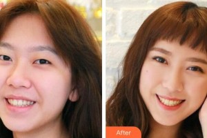 萍鄉(xiāng)星悅醫(yī)療美容診所胡喬整形價格表附切開雙眼皮案例展示