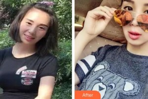 萍鄉(xiāng)優(yōu)美醫(yī)療美容門診部顏百俊整形價格表附超聲提拉案例展示