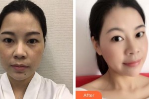 萍鄉(xiāng)薇尚醫(yī)療美容醫(yī)院李金文整形價(jià)格表附埋線提升案例展示