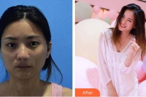 萍鄉(xiāng)薇尚醫(yī)療美容醫(yī)院賴啟煜整形價(jià)格表附埋線提升案例展示