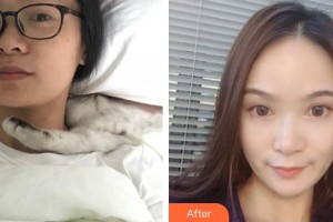 萍鄉(xiāng)恒生醫(yī)療美容診所鐘一鳴整形價(jià)格表附熱瑪吉案例展示