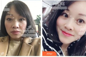 萍鄉(xiāng)星悅醫(yī)療美容診所陶軍整形價(jià)格表附埋線提升案例展示