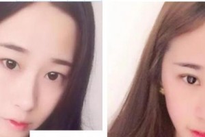 萍鄉(xiāng)愛爾眼科醫(yī)院李邦整形價(jià)格表附切開雙眼皮案例展示