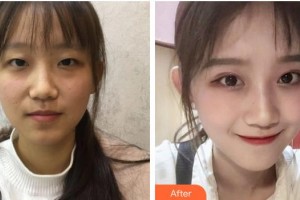 萍鄉(xiāng)星悅醫(yī)療美容診所付騰鵬整形價格表附開內(nèi)眼角案例展示