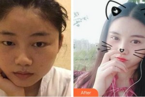 萍鄉(xiāng)愛爾眼科醫(yī)院胡發(fā)整形價格表附切開雙眼皮案例展示