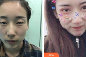 萍鄉(xiāng)愛爾眼科醫(yī)院楊明整形價格表附切開雙眼皮案例展示