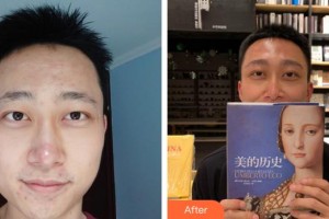 萍鄉(xiāng)龍琪口腔門診部周文濤整形價格表附種眉毛案例展示