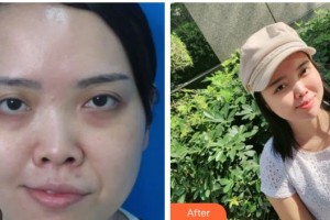 萍鄉(xiāng)星悅醫(yī)療美容診所曹斯頔整形價(jià)格表附激光去眼袋案例展示