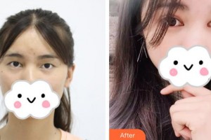 萍鄉(xiāng)市第二人民醫(yī)院眼科陳發(fā)春整形價(jià)格表附切開雙眼皮案例展示