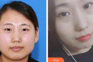 萍鄉(xiāng)市第二人民醫(yī)院眼科汪同祖整形價(jià)格表附切開雙眼皮案例展示