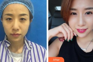 萍鄉(xiāng)市第二人民醫(yī)院眼科徐萍整形價(jià)格表附切開雙眼皮案例展示