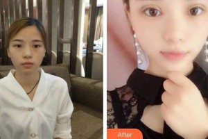 萍鄉(xiāng)薇尚醫(yī)療美容醫(yī)院沈洪元整形價(jià)格表附切開雙眼皮案例展示