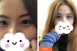 九江臺(tái)美整形美容醫(yī)院許言午整形價(jià)格表附切開雙眼皮案例展示