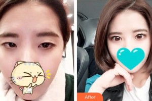 九江市第一人民醫(yī)院整形科趙云杰整形價(jià)格表附眼部綜合案例展示