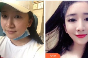 九江市第一人民醫(yī)院整形科宗艷霞整形價(jià)格表附切開雙眼皮案例展示