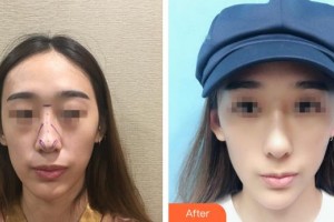 九江協(xié)和瑞美醫(yī)療美容門診部游鵬飛整形價(jià)格表附鼻部綜合案例展示