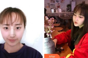 九江協(xié)和瑞美醫(yī)療美容門診部吳偉林整形價(jià)格表附鼻部綜合案例展示