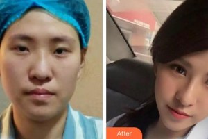 九江圣嘉麗醫(yī)療美容門診部高鵬整形價(jià)格表附膨體隆鼻案例展示