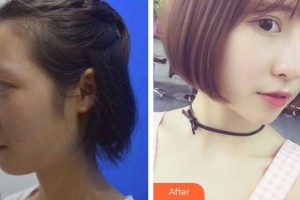 九江瑞麗醫(yī)療美容醫(yī)院王萌整形價(jià)格表附鼻部綜合案例展示