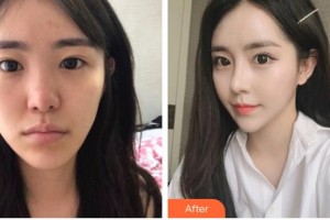 九江學(xué)院附屬醫(yī)院整形美容科詹太國整形價格表附鼻部綜合案例展示