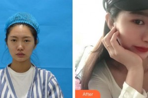 九江市婦幼保健院眼科唐衛(wèi)華整形價格表附鼻部綜合案例展示