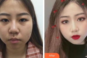 九江風(fēng)華醫(yī)療美容門診部黃健生整形價格表附假體隆鼻案例展示