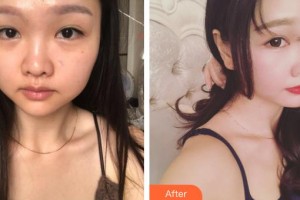 九江瑞麗醫(yī)療美容醫(yī)院萬成整形價格表附肋軟骨隆鼻案例展示