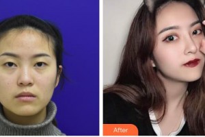 九江風(fēng)華醫(yī)療美容門診部宋志剛整形價格表附鼻部綜合案例展示