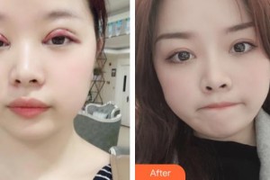 九江愛爾中山眼科醫(yī)院高崇惠整形價格表附切開雙眼皮案例展示