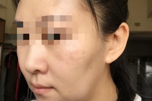 贛州華美醫(yī)療美容門(mén)診部劉兵整形價(jià)格表附面部年輕化案例展示