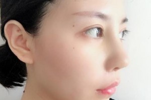 贛州華美醫(yī)療美容門(mén)診部覃潔敏整形價(jià)格表附隆鼻案例展示