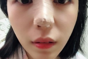 贛州華美醫(yī)療美容門(mén)診部吳曉宇整形價(jià)格表附隆鼻案例展示