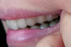 贛州衛(wèi)華口腔醫(yī)院高紅波整形價格表附口腔綜合案例展示